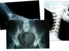 Artificiële intelligentie helpt radiologen van UZA levens redden