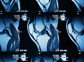 Belgische AI helpt bij de diagnose van artritis op basis van MRI-beelden