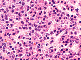Apport de l’isatuximab avec ou sans dexaméthasone dans le myélome multiple récidivant ou réfractaire