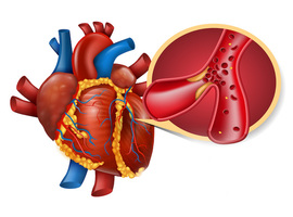 Infarctus du myocarde: l’alirocumab favorise davantage la régression des plaques chez les patients moins à risque