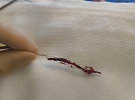 Thrombectomie : cap des 180 procédures franchi en 2025 en région liégeoise