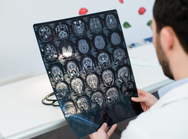 Un nouveau test permet de déterminer la meilleure façon de traiter une tumeur cérébrale