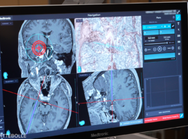 Une opération moins invasive pour traiter l'épilepsie réfractaire aux médicaments