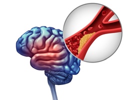 Efficacité du ténectéplase administré entre 4,5 et 24 heures après AVC ischémique sans thrombectomie