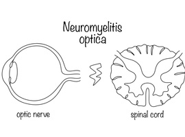 L’éculizumab, efficace dans les poussées aiguës du trouble du spectre de la neuromyélite optique