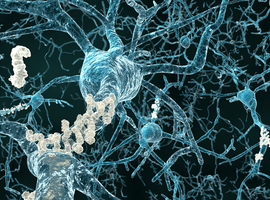 Atrofie van de hippocampus bij de ziekte van Alzheimer