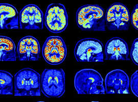 Wereldprimeur voor UZ Leuven: PET-scanner helpt hersenziekten vroegtijdig opsporen 