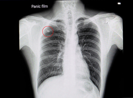 Une Clinique des nodules pulmonaires à Liège, une première en Wallonie