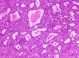 Le nivolumab dans le carcinome  hépatocellulaire avancé