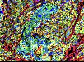 Cancer : l'ULB identifie de nouvelles cibles potentielles contre les métastases