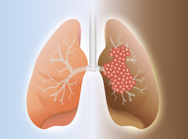 Longkanker:  nivolumab plus ipilimumab bij hoge mutatielading