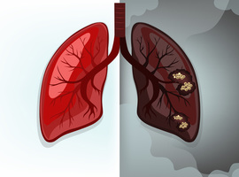 Psychologische ondersteuning Belgische longkankerpatiënten kan beter