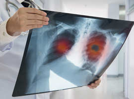 Cancer du poumon : une plateforme informatique pour connaître les essais cliniques en cours dans le monde
