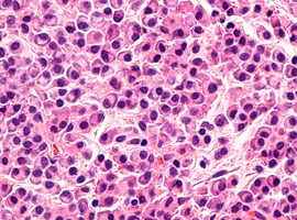 La greffe de cellules souches autologues reste utile dans le traitement du myélome