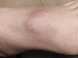 Tuméfaction douloureuse des tissus mous du dos du pied chez un enfant: granulome annulaire sous-cutané
