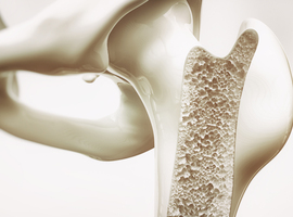 Le manque d'informations sur l'ostéoporose empêche sa détection précoce