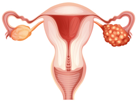 Cancer de l’ovaire récidivant sensible au platine: une dose individualisée de niraparib en entretien renforce la sécurité sans altérer l’efficacité