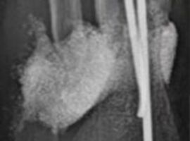 Une thérapie belge évite l'amputation chez quatre enfants atteints d'une maladie osseuse