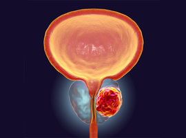 Onderzoekers pleiten voor bijkomende biopsieën om prostaatkanker te analyseren