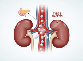 Finérénone + empagliflozine dans la maladie rénale chronique et le diabète de type 2