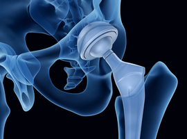 Prothèse de la hanche :   6 recommandations de bonne pratique et 11 points d’amélioration (Audit)