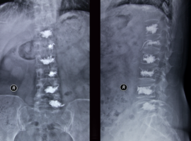 Vertebroplastie versus sham-ingreep voor pijnlijke acute osteoporotische wervelcompressiefracturen