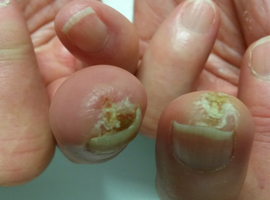 Update over sclerodermie en het belang van een (video)capillaroscopie  van de nagelriem