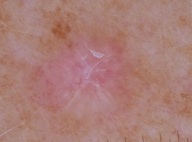 Dermoscopie des lésions solitaires: carcinome basocellulaire versus lichen plan