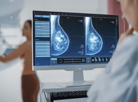 Le dépistage individualisé du cancer du sein