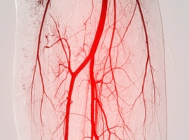 Urgenties: perifeer arterieel lijden