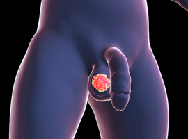 Les cancers du testicule restent rares, mais ils augmentent chez les 24-35 ans