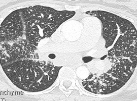 Le microbiome dans les pathologies interstitielles pulmonaires