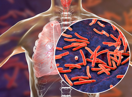 Damiaanactie trekt aan alarmbel nu aantal tuberculosebesmettingen stijgt