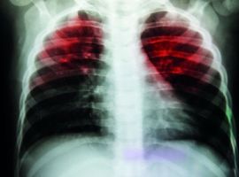 Tuberculose: een korte behandeling voor kinderen