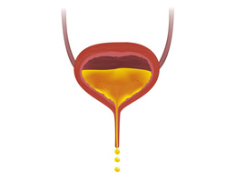 Wat is de beste slingprocedure voor behandeling van urine-incontinentie bij inspanning?