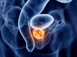 Prostaatkanker: diagnostische waarde van een combinatie van de serumspiegels van PSA, TGF-β1 en p2PSA
