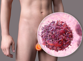 Les cancers les plus fréquemment responsables d’une métastase testiculaire