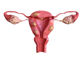 Uteriene fibromen: historiek en overzicht van medicamenteuze behandelingsmogelijkheden