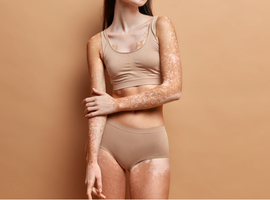 Mieux connaître la distribution des signes cliniques du vitiligo pour mieux le suivre
