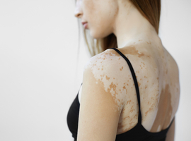 Nieuwe perspectieven bij de behandeling van vitiligo