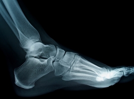 Service d’orthopédie-traumatologie: Chirurgie percutanée de l’avant-pied 