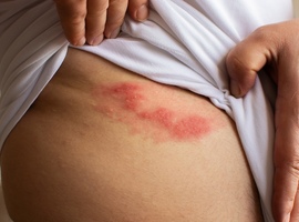 Traitement de la douleur du zona aigu et de la névralgie post-herpétique