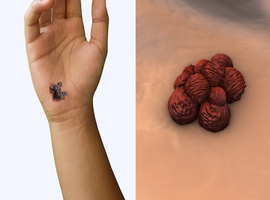 Du désespoir à l’espoir: comment la révolution thérapeutique a transformé le mélanome métastatique en une maladie enfin traitable