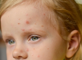 Eerste minderjarige in België besmet met apenpokkenvirus