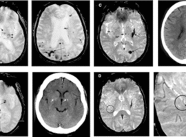 Incidentaloom: toevallige ontdekking van cerebrovasculair letsel met MRI