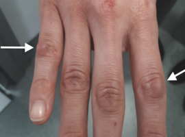 Focale zwelling aan de vingers: belang van correlatie klinisch beeld met beeldvorming
