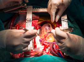 Pontage aorto-coronarien pour la coronaropathie multitronculaire: quo vadis?