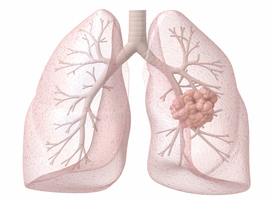 La place de la chirurgie dans le traitement du cancer du poumon non à petites cellules oligométastatique