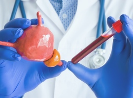 PSA: vriend of vijand? Is screening echt nodig? Rol van genetica