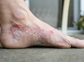 Hypothetisch verband tussen psoriasis en tuberculose